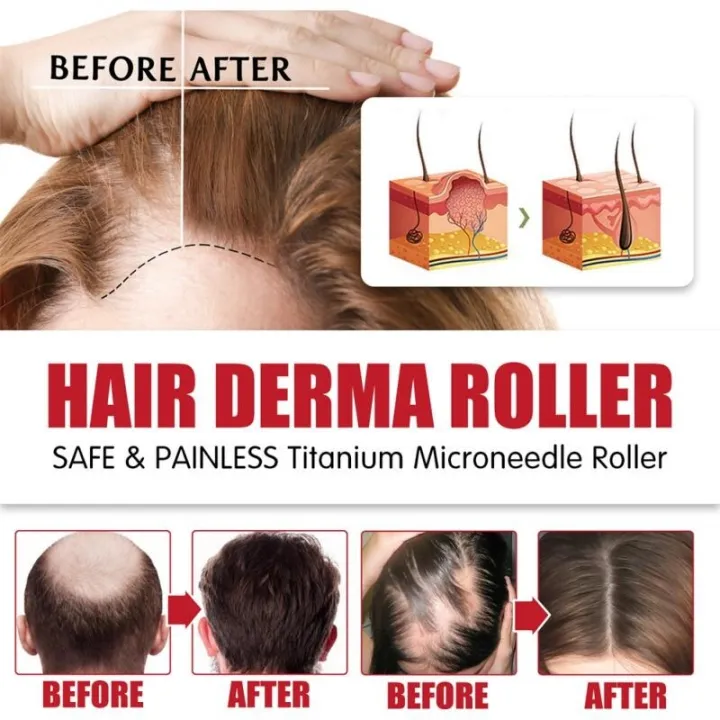 New%20Dermaroller%20For%20Men%20Micro%20Hair%20Derma%20Roller%20Regrowth%20Beard%20Growth%20Anti%20Loss%20Roll%20Tool%20%E3%80%90hot%E3%80%91%E2%99%82%E2%9C%B4%E2%9C%93%20-%20Image%204