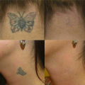 Permanent Tattoo Removal Cream Safe Removing Maximum Strength Cleaning. 