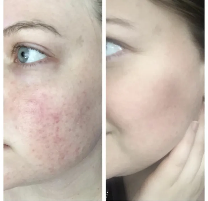 The%20Ordinary%20Retinol%200.5%25%20in%20Squalane%20-%20Image%202