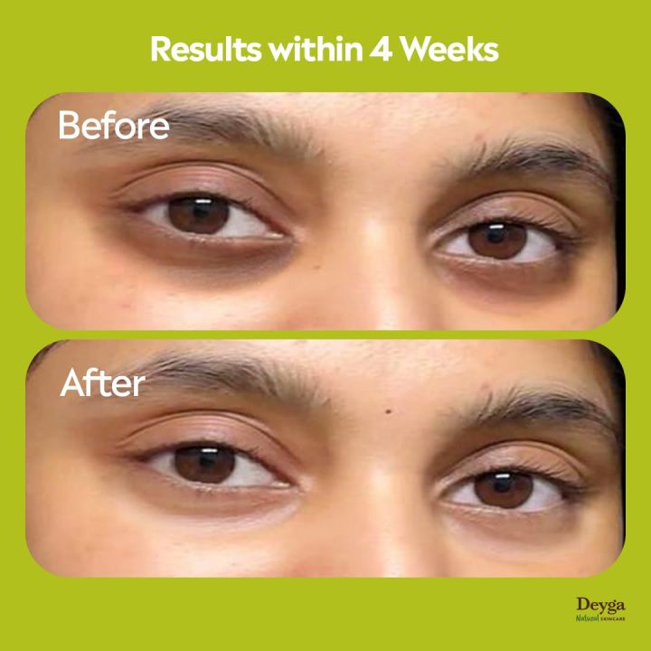 Deyga%20Under%20Eye%20Cream%20(15%20Gm)%20%7C%20Lightens%20Dark%20Circles%20%7C%20Reduces%20Puffiness%20&%20Fine%20lines%20%7C%20Chemical-free%20%7C%20Suits%20Men%20and%20Women%20%7C%20Reduces%20Dark%20Circles,%20Wrinkles,%20and%20Fine%20Lines(From%20india)%20-%20Image%202