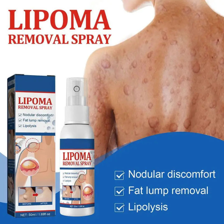 Lipoma%20Removal%20Spray%20Anti%20Tumor%20Skin%20Swelling%20Pain%20Lipolysis%20Cellulite%20Treatment%20Fibroma%20Subcutaneous%20Fat%20Lump%20Relief%20Cream%2050ml%20-%20Image%204