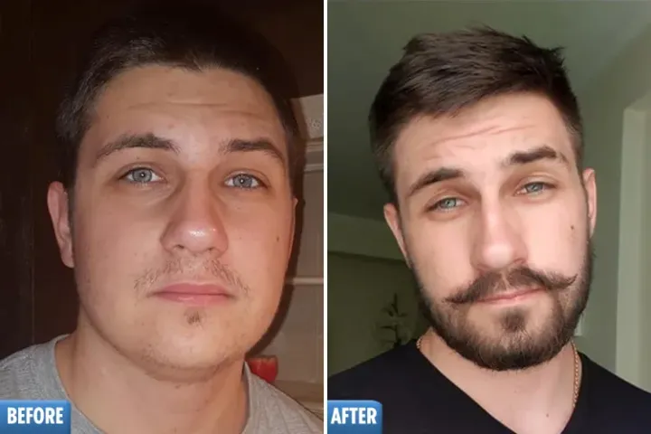 Imported%20Kirkland%20Minoxidil%205%25%20Hair%20Regrowth%20Solution%20for%20Men%20with%20Dropper%20Applicator%20-%201%20Month%20Supply%20%7C%20KIRKLAND%20MINOXIDIL%205%25%20USA%20HAIR%20&%20BEARD%20REGROWTH%20TREATMENT%20-%20Image%207
