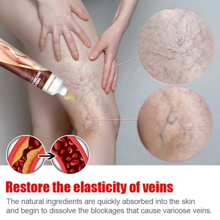 20g%20Relaxing%20Leg%20Cream%20Eliminate%20Vasculitis%20Phlebitis%20Spider%20Vein%20Care%20Leg%20Cream%20Improves%20Blood%20Circulation%20Anti%20Varicose%20Cream%20-%20Image%202