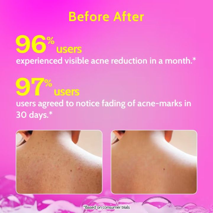 CHEMIST%20AT%20PLAY%20%201%25%20Salicylic%20Acid%20Acne%20Body%20Wash%20236ML%20-%20Image%202