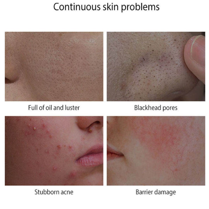 Salicylic%20Acid%20Acne%20Treatment%20Cream%20Acne%20Remover%20Face%20Cream%20Remove%20Deep%20Acne%20Scars%20Gel%20Oil%20Control%20Shrink%20Pores%20Blackheads%20Care%20-%20Image%202