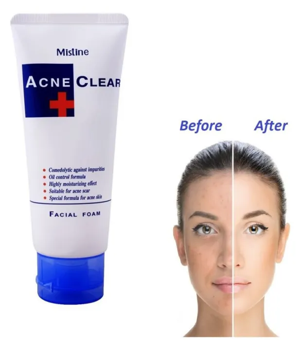 Mistine%20ACNE%20Clear%20Facial%20Foam%20Face%20Wash%20Thailand%2085gms%20-%20Image%202