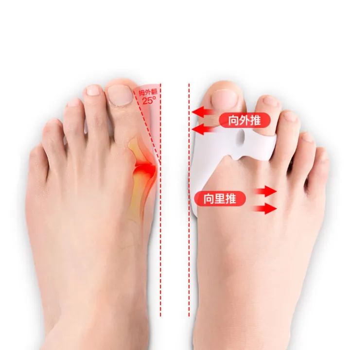 Spine%20Supporters%20Toe%20corrector,%20toe%20splitter,%20correction%20of%20big%20toe%20toe,%20wearable%20shoes,%20soft%20rubber,%20and%20thumb%20eversion%20tool,%20directly%20sold%20by%20manufacturer%20-%20Image%202