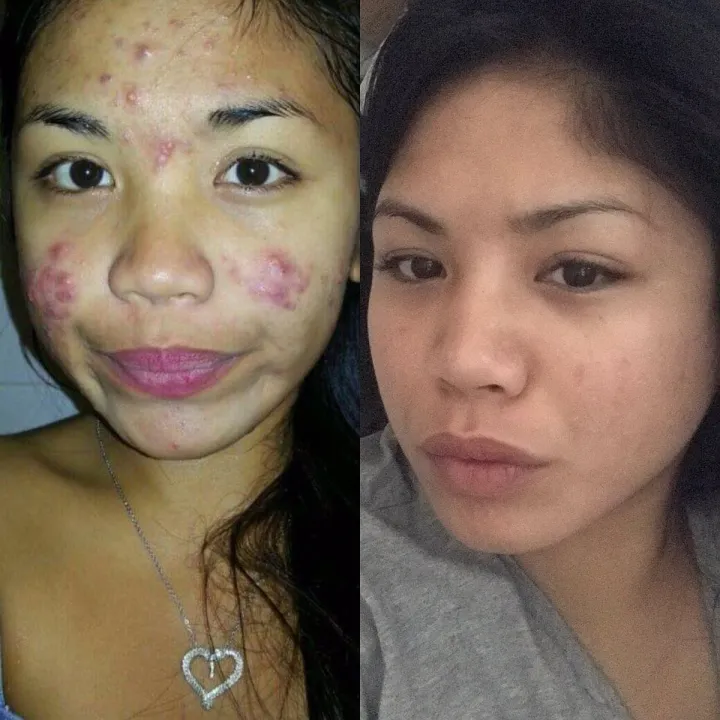 RDL%20papaya%20whtiening%20soap%20135g%20%20and%20Hydroquinone%20baby%20face%2060ml%20(%20solution*2)%202en1%20pack%20-%20Image%205