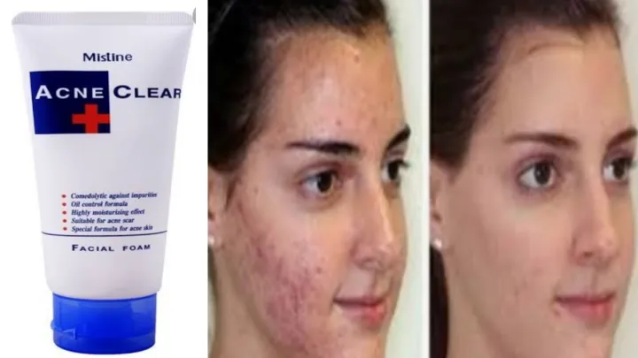Mistine%20ACNE%20Clear%20Facial%20Foam%20Face%20Wash%20Thailand%2085gms%20-%20Image%203