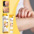 Bee Venom Vitiligo Treatment Cream Natural Relief Skin Treatment Soothing White Spot Removal Vitiligo Ointment Eliminate Pigment. 