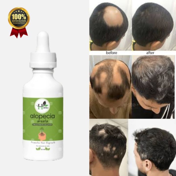 Haryali Hair Regrowth Oil Alopecia Areata Treatment hair care treatment instant hair fall