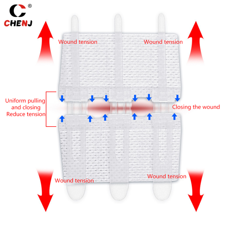 Closure Patch Zipper Wound Closure Patch Zipper Band-Aid Wound Fast Suture Outdoor ...