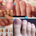 7 Day Nail Fungal Treatment Serum Foot Toe Nail Fungus Removal Essential Oil Infection Onychomycosis Paronychia Repair Gel. 