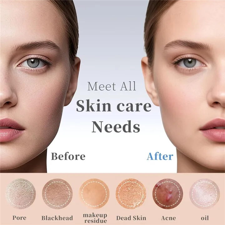 Blackhead%20Black%20Head%20Remover%20Tools,%20Deep%20Pore%20Cleaner%20for%20Face%20and%20Nose,%20Skin%20Care%20Tools%20for%20Daily%20Use%20-%20Image%203