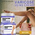 Varicose Vein Treatments Cream Effective Relieve Legs Dilated Vasculitis Phlebitis Natural Formula Ointment For Varicose Veins. 