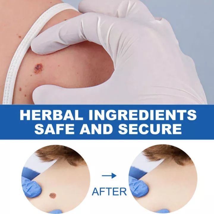 Relax%20day%E3%80%90EELHOE%E3%80%91%20Wart%20Removal%20Pen%20Krim%20Penghilang%20Lalat,%20Krim%20Penghilang%20Kutil,%20Mudah%20Dibawa%20Untuk%20Semua%20Kulit,%20Krim%20Penghilang%20Kutil%20remove%20skin%20tag%20warts%20remover%20original%20cream%20-%20Image%206