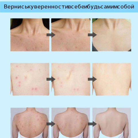 Anti%20Mite%20Itching%20Shower%20300ml%20*3%20Acne%20body%20wash%20sabun%20jerawat%20badan%20hilang%20jerawat%20Whitening%20Shower%20Gel%20Itchy%20Antibacterial%20body%20wash%20Remove%20Mites%20Whitening%20(FROM%20MALAYSIA)%20-%20Image%202