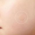 Tea Tree Essential Acne Patches Waterproof Pimple Patch for Control, Redness Repair, Whitehead Improvement Skin Care. 