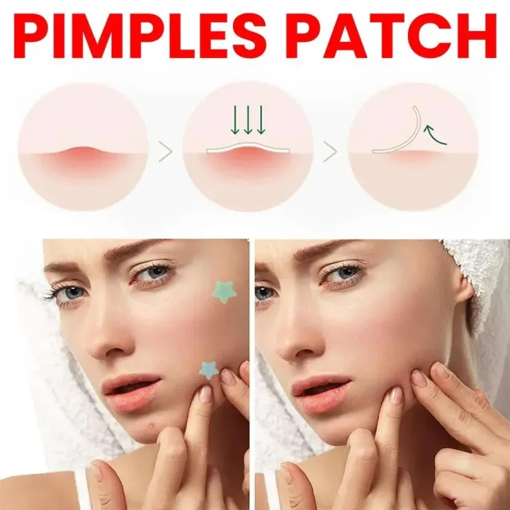 NEW%20200pcs%20Star%20Pimple%20Patch%20Acne%20Colorful%20Invisible%20Acne%20Removal%20Skin%20Care%20Stickers%20Face%20Spot%20Beauty%20Makeup%20Tool%20-%20Image%205