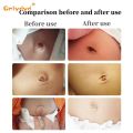 Infant Inguinal Umbilical Hernia Belt Navel Support Stickers Treatment Newborn Baby Belly Button With 3 Hernia Pad. 