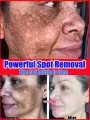dark spot remover Melasma Chloasma black spots cream JinSong77. 