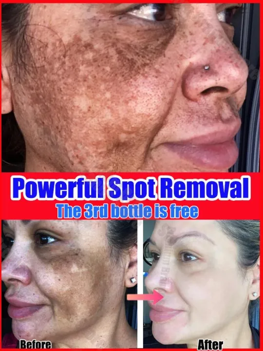 dark spot remover Melasma Chloasma black spots cream JinSong77