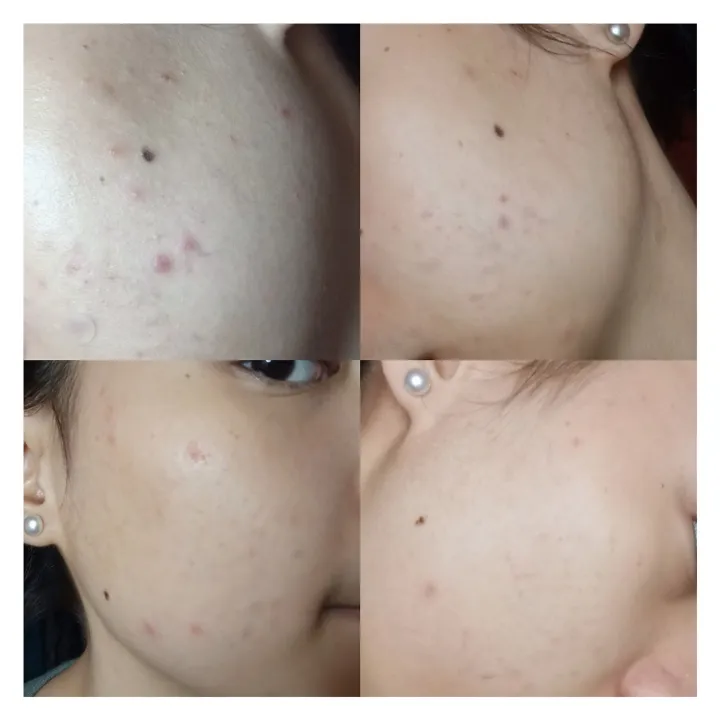 RDL%20papaya%20whtiening%20soap%20135g%20%20and%20Hydroquinone%20baby%20face%2060ml%20(%20solution*2)%202en1%20pack%20-%20Image%206