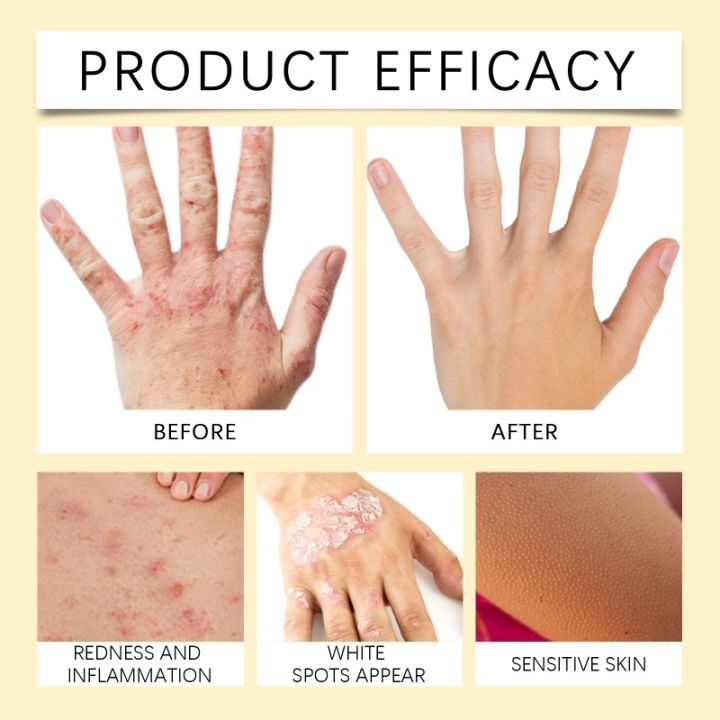 Bee%20Venom%20Vitiligo%20Treatment%20Cream%20Natural%20Relief%20Skin%20Treatment%20Soothing%20White%20Spot%20Removal%20Vitiligo%20Ointment%20Eliminate%20Pigment%20-%20Image%204