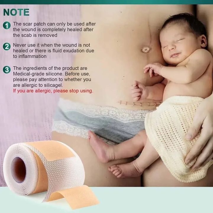 1%20Roll%20Reusable%20Scars%20Removal%20Sheets,Silicone%20Scars%20Sheets%20Tape%20for%20Surgical%20Scars,Healing%20Keloid,C-Section,Tummy%20Tuck,Burn,Acne%20-%20Image%206