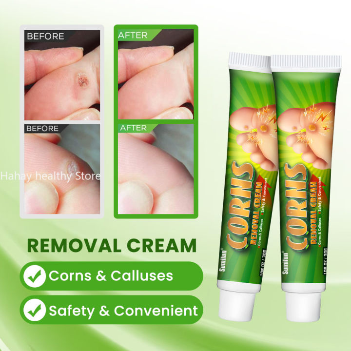 Foot%20Corn%20Remover%20Cream%20Chicken%20Eye%20Skin%20Infection%20Treatment%20Ointment%20Feet%20Dead%20Skin%20Calluses%20Removal%20Tool%20Health%20Care%20%EB%82%B4%EC%84%B1%EB%B0%9C%ED%86%B1%20-%20Image%206