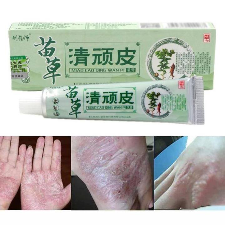 Chinese Herbal Medicine Skin For -itch Allergies Dermatitis Eczema ...