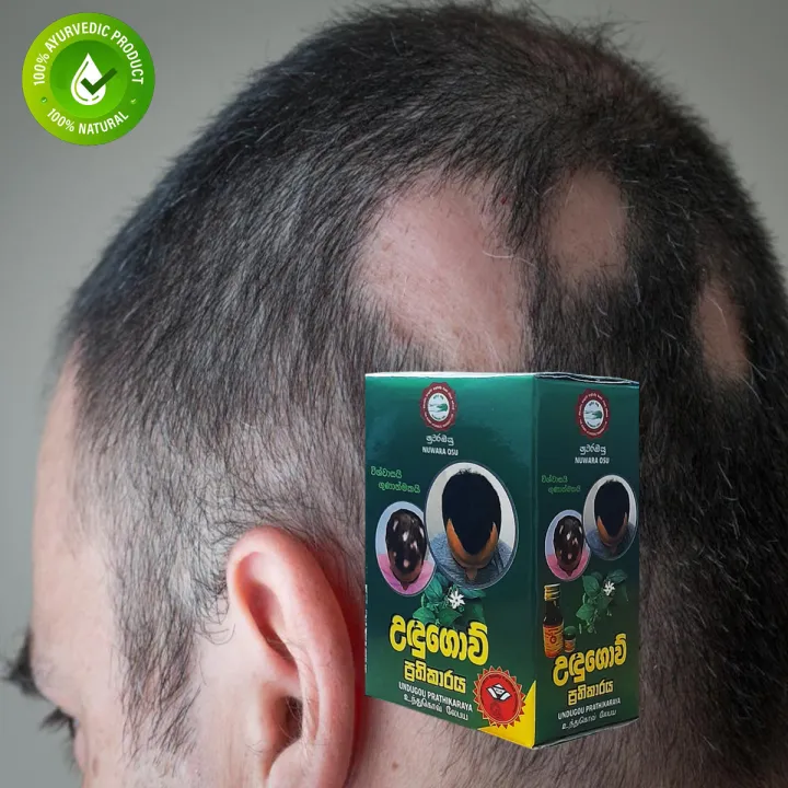 Ayurvedic Udugowwa Balm & Oil Pack – Effective Herbal Remedy for Hair Loss