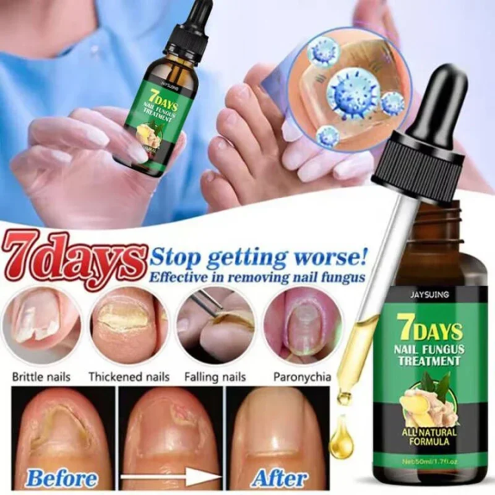 7%20Day%20Nail%20Fungal%20Treatment%20Serum%20Foot%20Toe%20Nail%20Fungus%20Removal%20Essential%20Oil%20Infection%20Onychomycosis%20Paronychia%20Repair%20Gel%20-%20Image%202