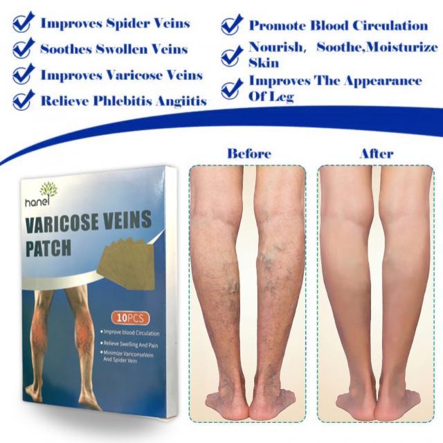 Varicose%20Veins%20Health%20Patch%2010%20Pcs%20-%20Image%204