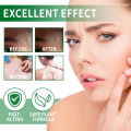 Folliculitis Antibacterial Cream Cysts Papules Spot Pustules Remover Scalp Follicles Blockage Itching Eczema Treatment Ointment. 