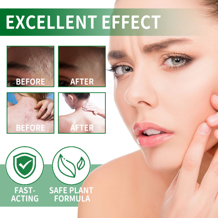 Folliculitis%20Antibacterial%20Cream%20Cysts%20Papules%20Spot%20Pustules%20Remover%20Scalp%20Follicles%20Blockage%20Itching%20Eczema%20Treatment%20Ointment%20-%20Image%205