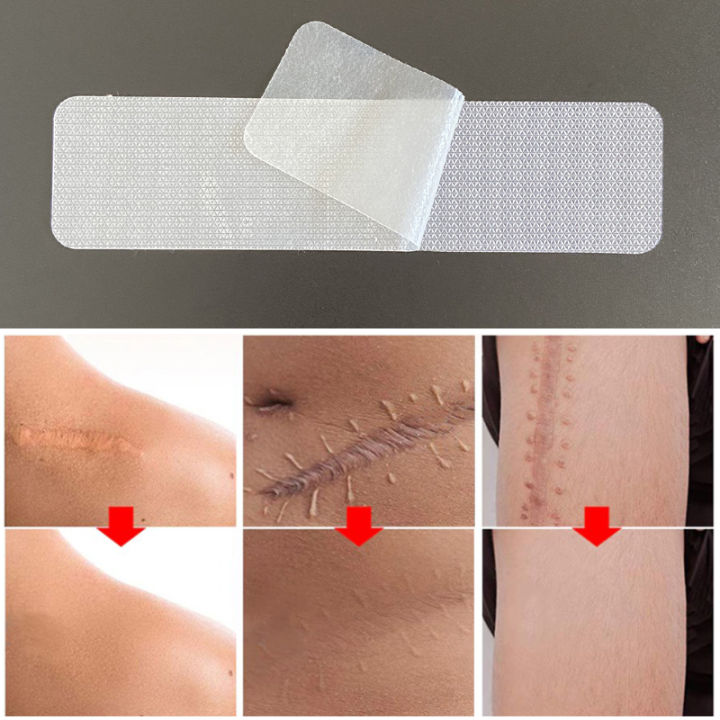 Scar%20tape,%20skin%20wound%20high-efficiency%20hand%20silicone%20sheet%20treatment%20patch,%204x15cm%20scar%20patch%20removal,%20ear%20orthosis%20skin%20burn%20repair%20-%20Image%203