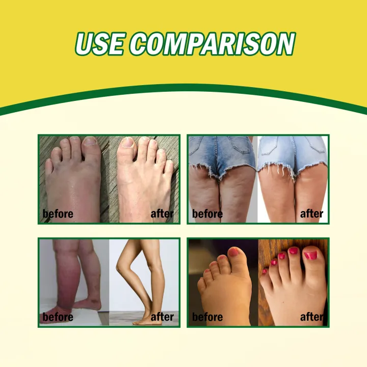 Leg%20Swelling%20Relief%20Cream%20Joint%20Soreness%20Pain%20Therapy%20Legs%20Edema%20Treatment%20Slimming%20Detoxifying%20Dehumidification%20Care%20Product%20-%20Image%204