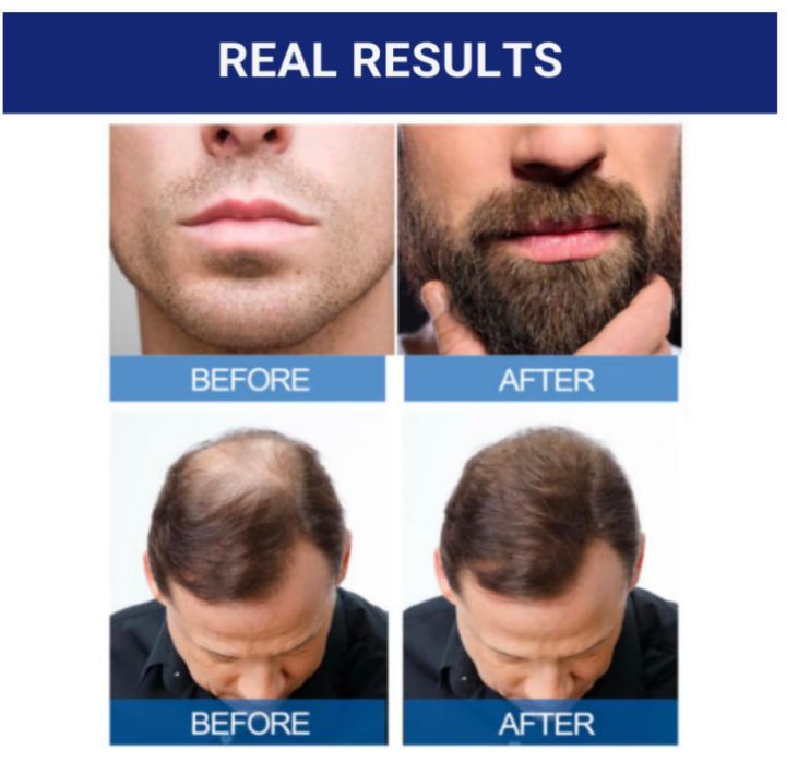 Kirkland%20Minoxidil%205%20%25%20Topical%20Solution%20USP%2060ml%20Original%20-%20One%20Month%20Supply%20+%20Free%20Dropper%20%20-%20%20Hair%20Regrowth%20Treatment%20for%20Men%20-%20Made%20in%20USA%20-%20kirkland%20signature%20-%20Image%204