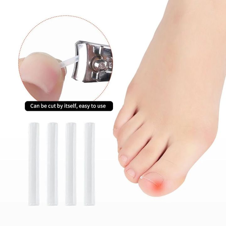 50Pcs/box%20New%20Brace%20Pedicure%20Tool%20Ingrown%20Toenail%20Correction%20Tool%20Filling%20Pad%20Nail%20Picker%20Elastic%20Patch%20Sticker%20Plastic%20Ingrown%20Toe%20Nail%20Treatment%20Straightening%20Clip%20-%20Image%206