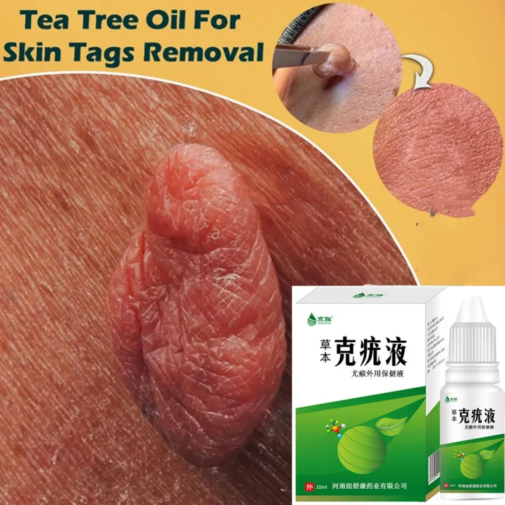 Kin Tag Liquid Nitro Wart Removal Liquid Skin Tag Filiform Warts Flat Warts Condyloma ...
