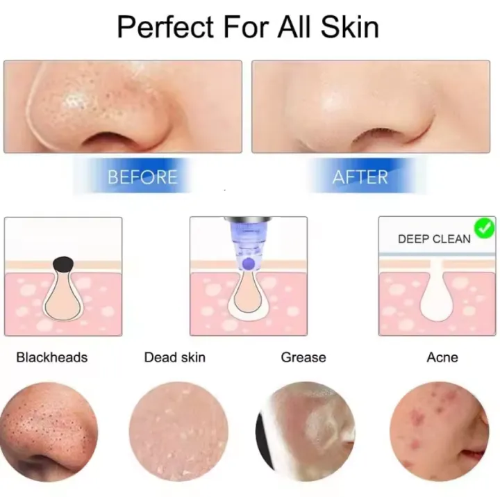 Blackhead%C2%A0Remover%C2%A0Facial%C2%A0Skin%C2%A0Cleanser%C2%A0Acne%C2%A0Vacuum%C2%A0Suction%C2%A0Pore%C2%A0Cleaner%C2%A0Machine%C2%A0Acne%C2%A0Remover%C2%A0Tool%C2%A0Kit%C2%A0Skin%C2%A0Care%C2%A0Beauty%20-%20Image%204