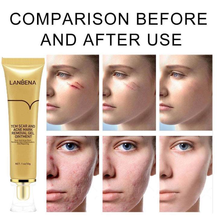 LANBENA%20TCM%20Scar%20&%20Acne%20Mark%20Removal%20Gel%20Ointment%20-%2030g%20-%20Image%203