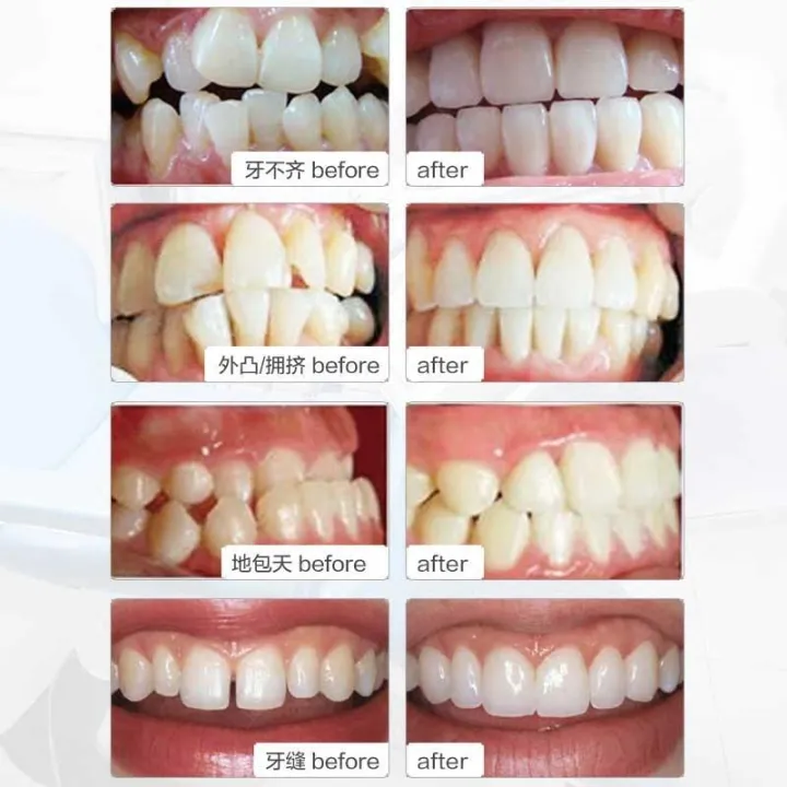 Dental Tooth Care Orthodontic Trainer Teeth Alignment Straight Adult Mouthpieces Brace Tray Mouthguard