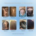 Growplex 5% Minoxidil Foam Targeted Scalp Treatment for Thinning Hair. 
