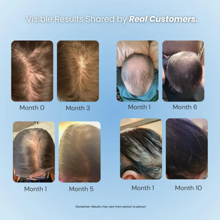 Growplex%205%25%20Minoxidil%20Foam%20Targeted%20Scalp%20Treatment%20for%20Thinning%20Hair%20-%20Image%203