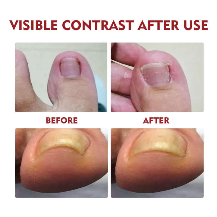 Jaysuing%20Soft%20Brightening%20Repair%20Ingrown%20Toenail%20Thickening%20Type%20Gray%20Nail%20Care%20Essence%20Oil%20-%20Image%204