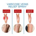 Spray for Varicose Veins Effective Varicose Vein Relief Cream To Relieve Leg Vasculitis Phlebitis Spider Pain Swelling Treatment. 