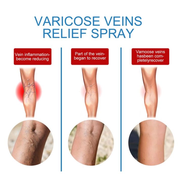 Spray%20for%20Varicose%20Veins%20Effective%20Varicose%20Vein%20Relief%20Cream%20To%20Relieve%20Leg%20Vasculitis%20Phlebitis%20Spider%20Pain%20Swelling%20Treatment%20-%20Image%203