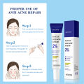 Salicylic Acid Acne Treatment Acne Remover Face Remove Deep Acne Scars Gel Oil Control Shrink Pores Blackheads Care. 